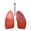 Human lung anatomy. Lung abscess. Royalty Free Stock Photo